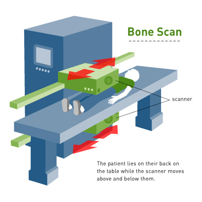 Bone Scan