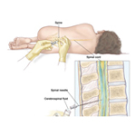 Lumbar Puncture