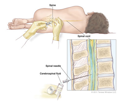 Lumbar-Puncture-Web