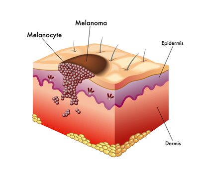 Skin Cancer
