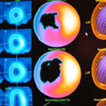 SPECT Scan